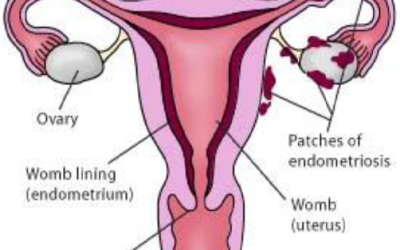 Natural Remedies for Endometriosis Symptoms