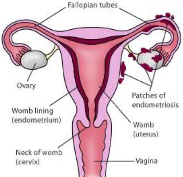 Natural Remedies for Endometriosis Symptoms